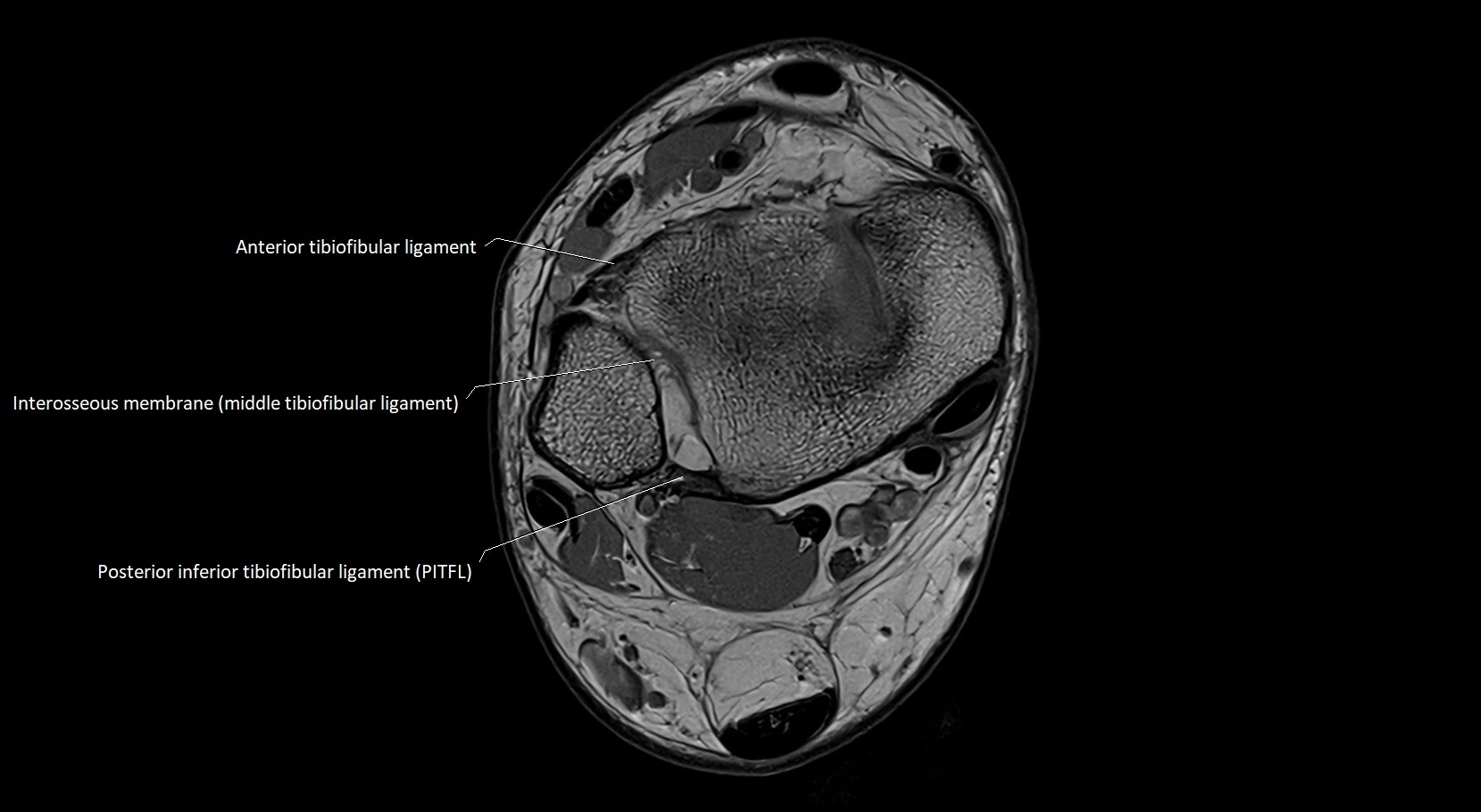 MRI ankle ligaments anatomy axial 3T image 2.webp